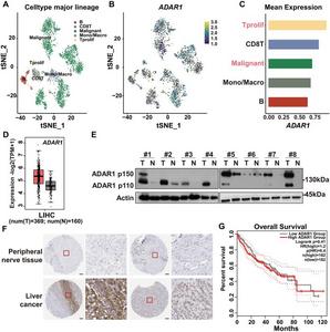 ADAR1 is aberrantly overexpressed in liver cancer tissues and associated with poor prognosis