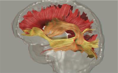 Brain Affected by Schizophrenia
