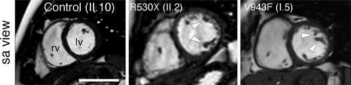 Specific modifier genes determine the effect of mutations that cause non-compaction cardiomyopathy