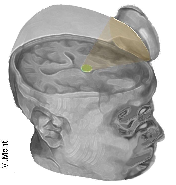 Targeting the Thalamus