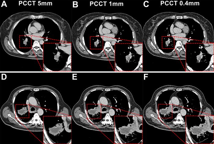 Photon-counting CT images of the lung.