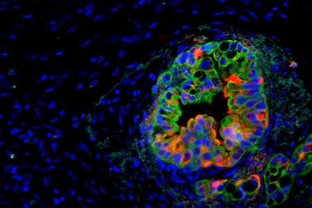 Pancreatic Cancer Imaging