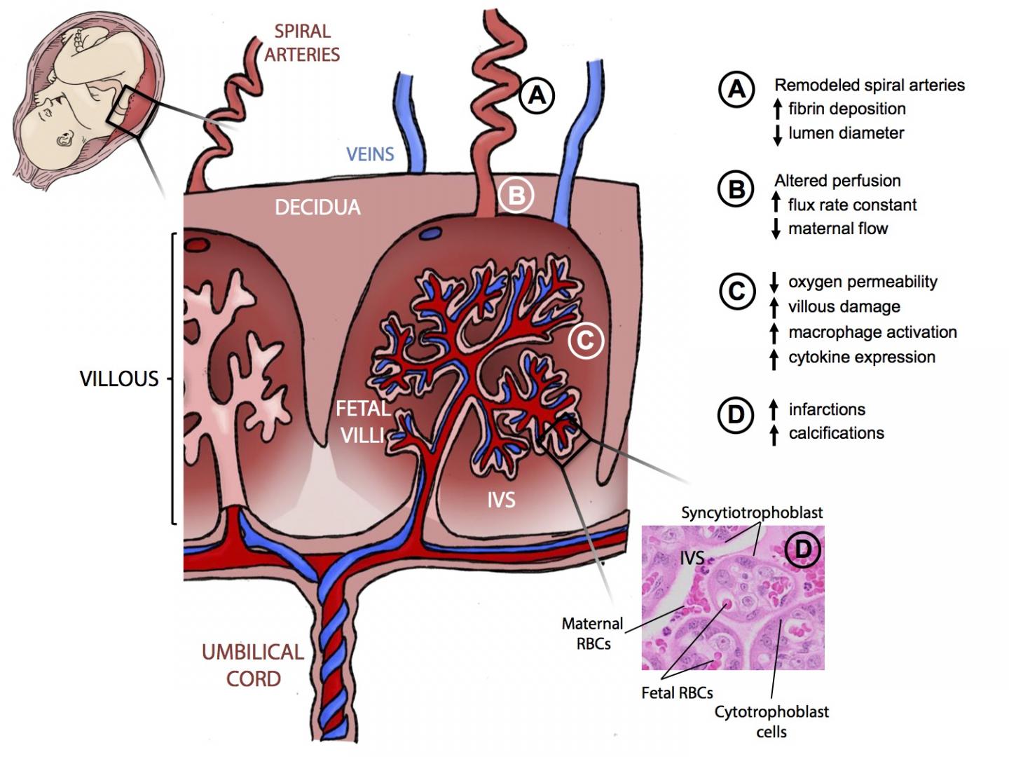 Zika Virus Affects the Placenta