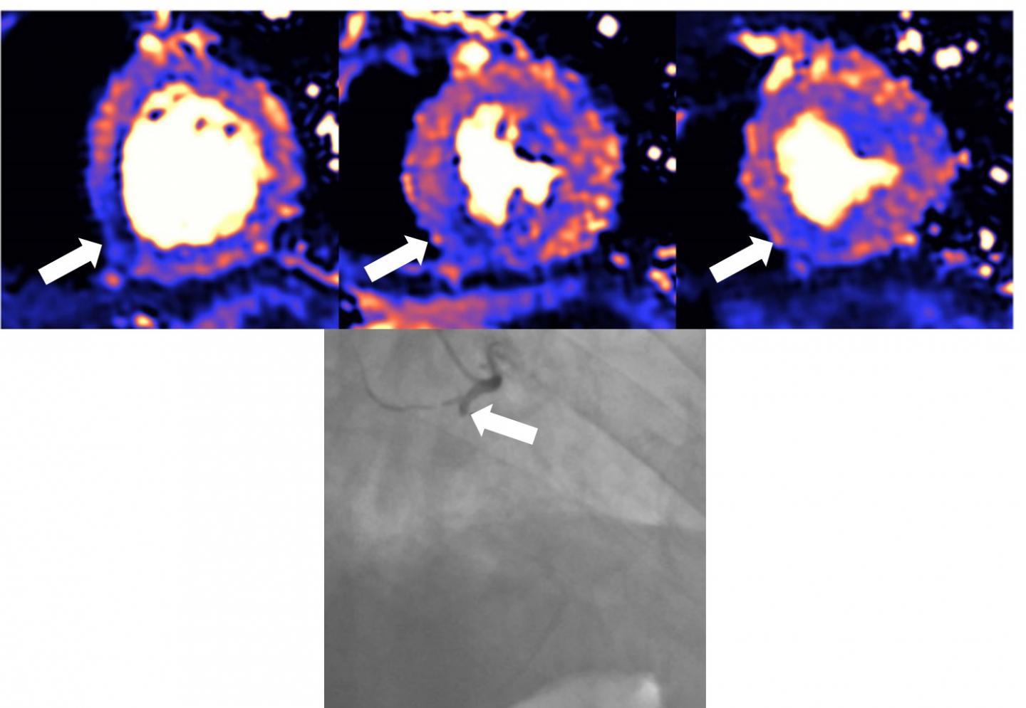 Damage to the heart found in more than half of COVID-19 patients discharged from hospital