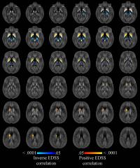 Quantitative Susceptibility Maps w/in Thalamus, Caudate, Globus Pallidus, & Putamen (3 of 3)