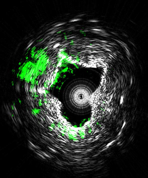 Intravascular Photoacoustic Imaging, a New Type of Medical Imaging Technology