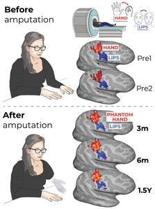 Brain activity maps for the hand and lips before and after amputation