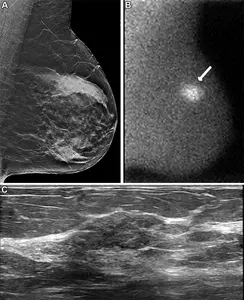 Images in a 57-year-old woman who presented for screening.