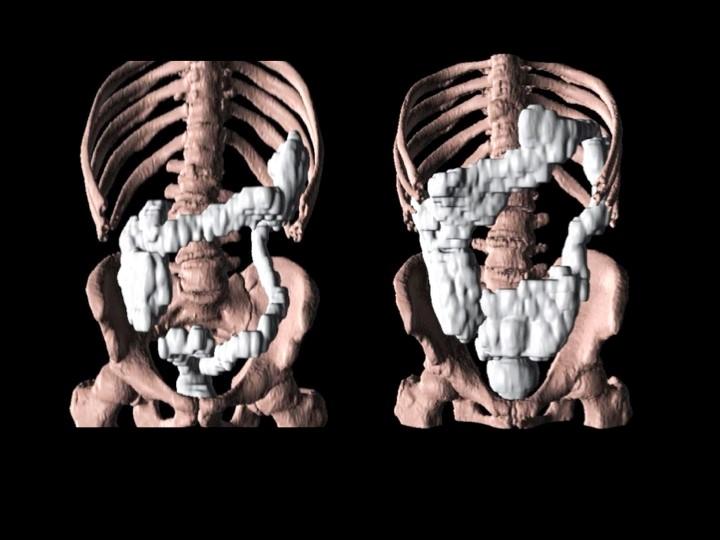 Colonic Volume 