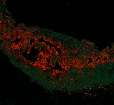 IL-17 Molecule 'Puts Band-Aid' on Heart Plaques (1 of 2)