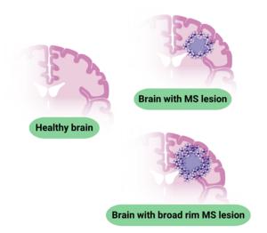 Different types of MS lesions