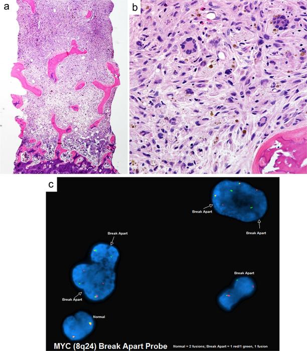 Example of histiocytic sarcoma secondary to T-lymphoblastic leukemia with MYC proto-oncogene (MYC) gene rearrangement