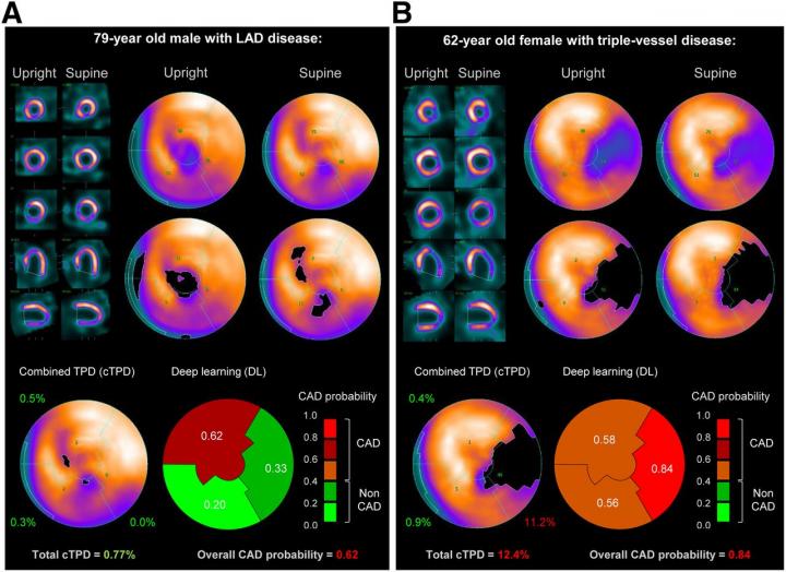 Prediction of Obstructive CAD from Upright and Supine Stress MPI