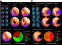 Prediction of Obstructive CAD from Upright and Supine Stress MPI