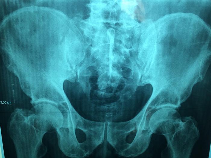 New AI tool predicts hip fracture risk better than current screening