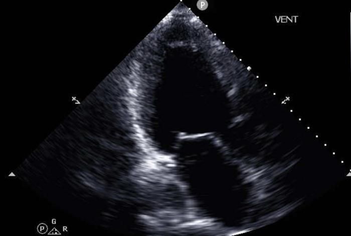 Representative echocardiographic image used to train a machine learning model to identify patients with heart failure
