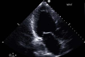 Representative echocardiographic image used to train a machine learning model to identify patients with heart failure