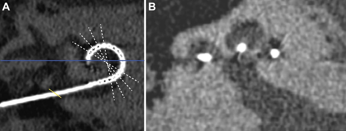 Cochlear Implants Linked to New Bone Formation, Increased Hearing Loss