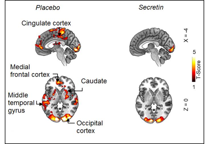 fMRI images showing diminished activity of reward circuits