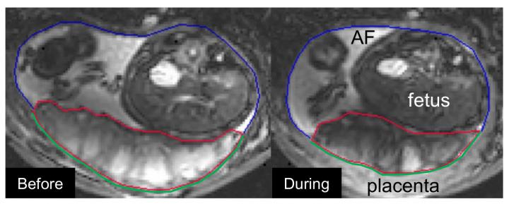 MRI Showing Contraction in Placenta