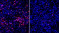 Neutrophils in Pancreatic Cancer