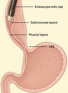 POEM procedure: Cross-sectional schematic of the distal esophagus and gastric cardia after submucosal tunnel formation and just before myotomy creation