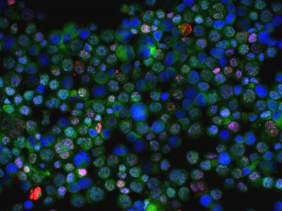 DNA Damaged Cells from a BRCA Mutation Carrier