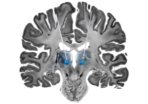 Stimulating the brain an evolving treatment for children with drug-resistant seizures