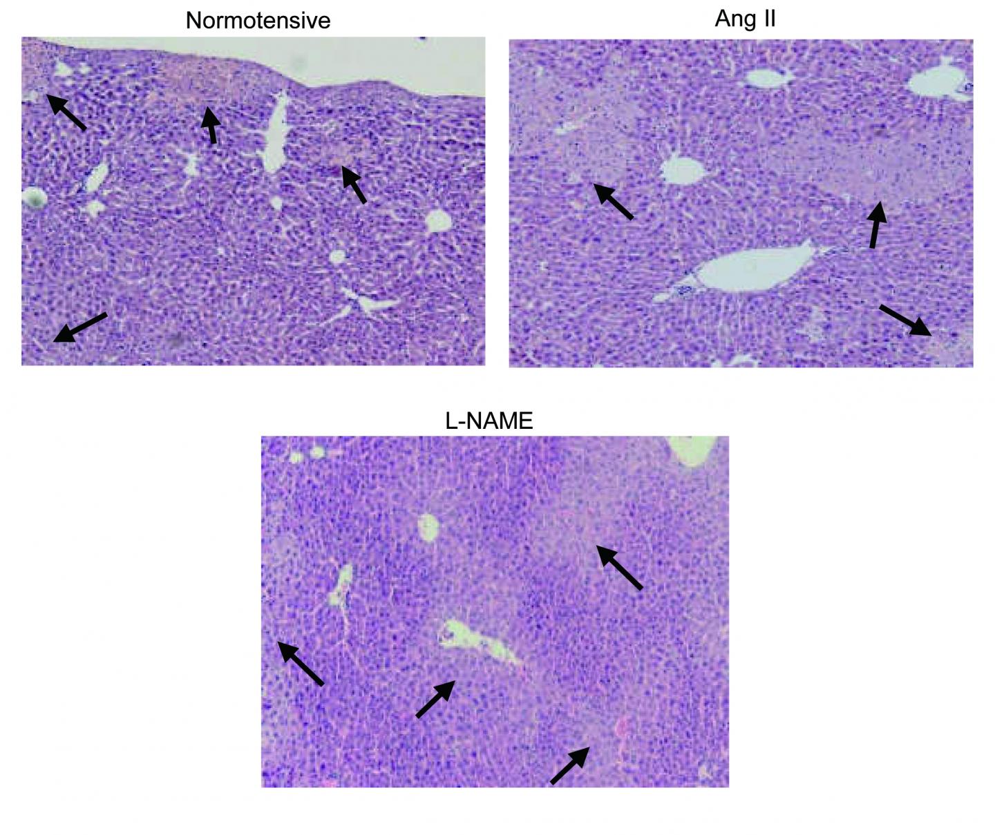 A Chicken and Egg Scenario: Molecular Pathway Triggers Cycle Beginning and Ending in Hypertension (1 of 1)