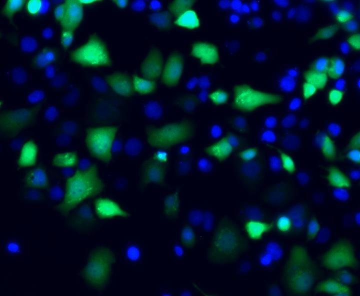 Human Liver Cells Infected with Hepatitis B