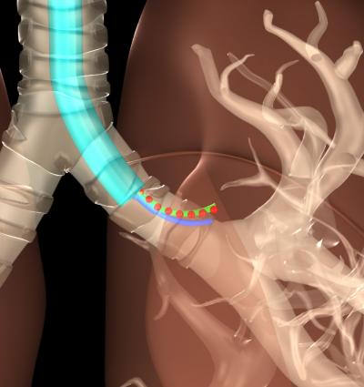 Tracking Invasive Surgical Tools