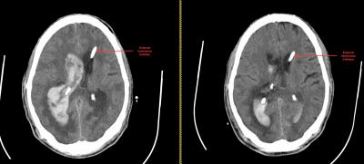 Clot-Busting Drug Effectively Clears Ventricular Blood