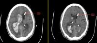 Clot-Busting Drug Effectively Clears Ventricular Blood