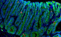 Adenoma