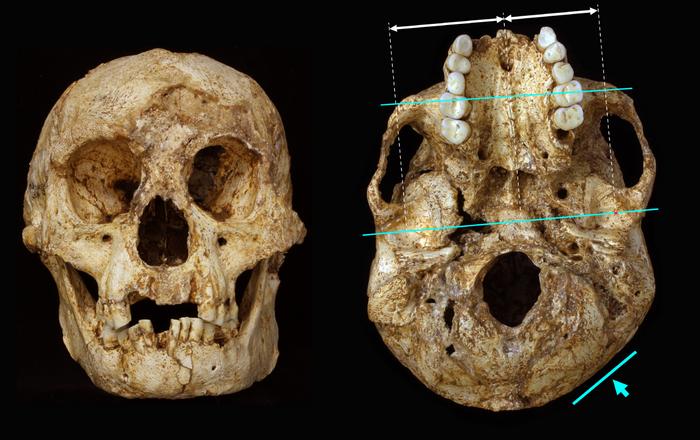 Cranial deformation in H. floresiensis