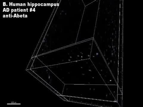 Plaques in Human Hippocampal Tissue