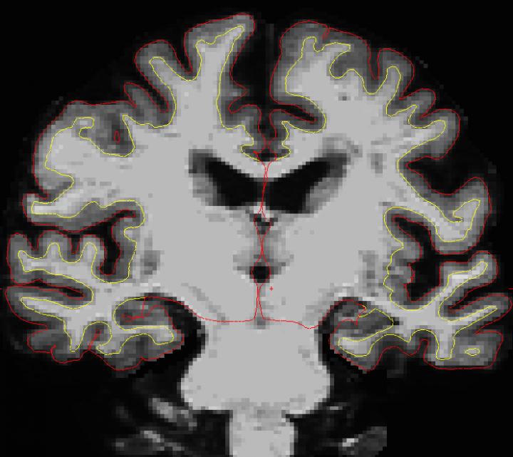 SuperAger Brain