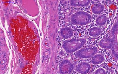 T Cells in Inflammatory Bowel Disease (2 of 2)