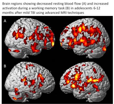 MRI Scans in Adolescent Following Mild Traumatic Brain Injury