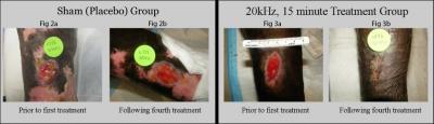 Therapeutic Ultrasound Heals Ulcers