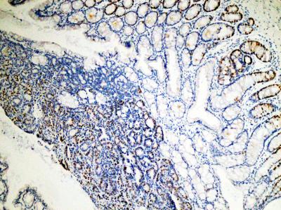 Intestinal Tumor