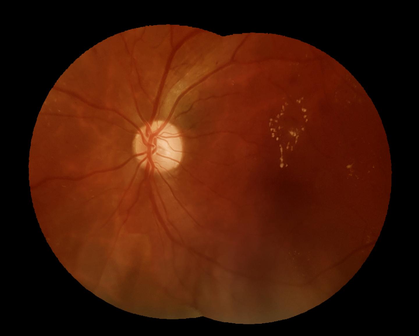 diabetic retinopathy