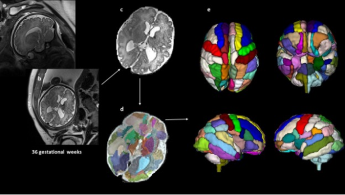 Prenatal brain scan analysis