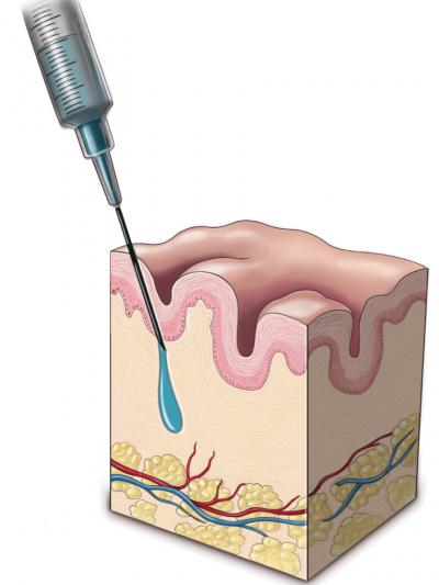 Light-Activated Facial Tissue Implants (1 of 3)