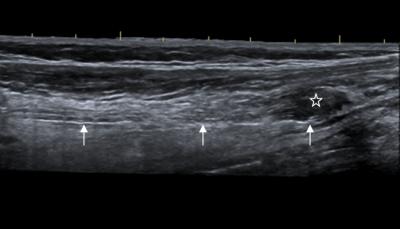 Median Nerve