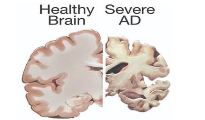 Healthy Brain versus Severe Alzheimer’s Disease