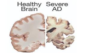 Healthy Brain versus Severe Alzheimer’s Disease