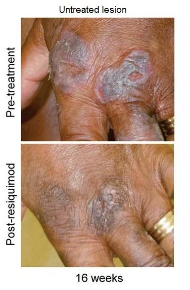 Untreated Lesion