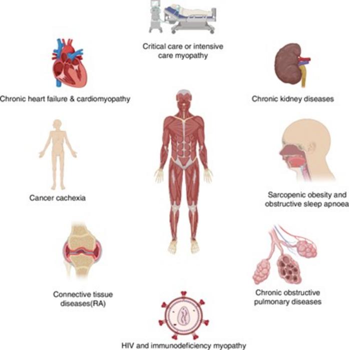 Myopenia’s Network: Disease-Linked Muscle Loss in Rheumatoid Arthritis
