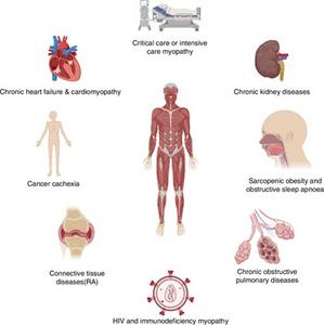 Myopenia’s Network: Disease-Linked Muscle Loss in Rheumatoid Arthritis